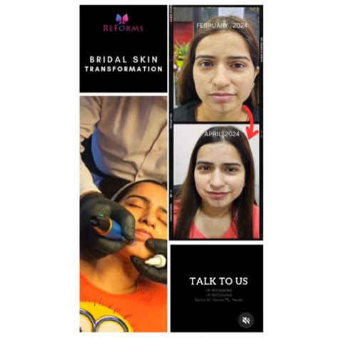 Top Pre-Bridal Skin Care Treatments in Noida for Radiant Wedding Skin