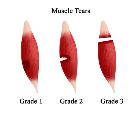 Muscle Strain–Torn Muscle–Muscle Tear - OrthoEducation