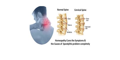 Ankylosing Spondylitis: Holistic Wellness - Shuddhi Ayurveda